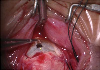 Uveal Effusion Syndrome: Clinical Characteristics, Outcome of Surgical Treatment, and Histopathological Examination of the Sclera